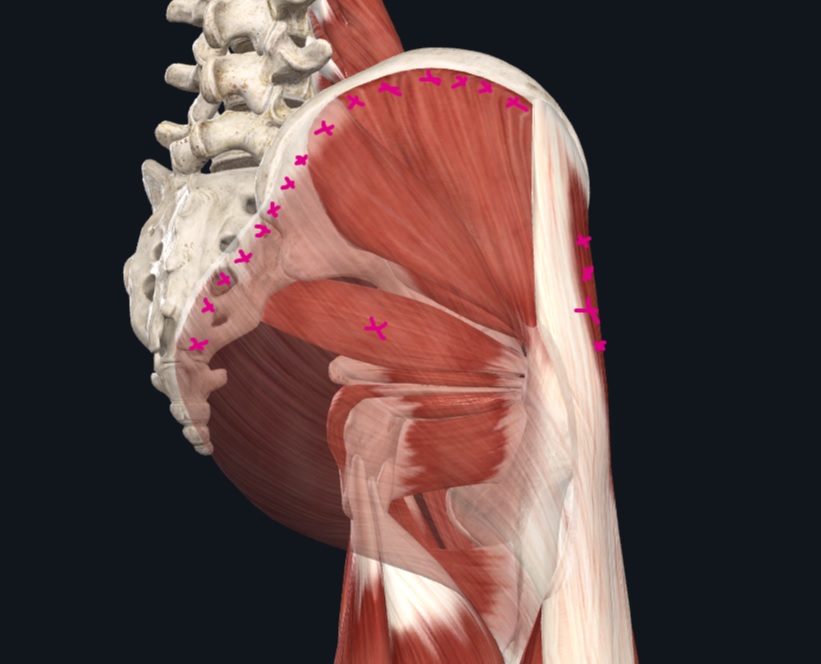 Pelvic Sore Points