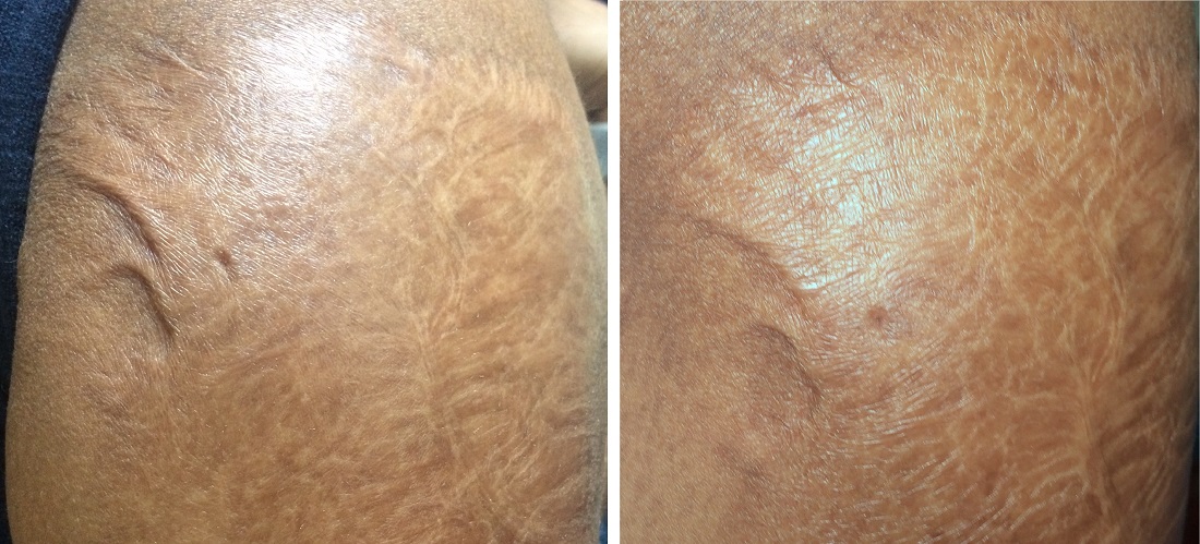 Before and after shoulder burn scar