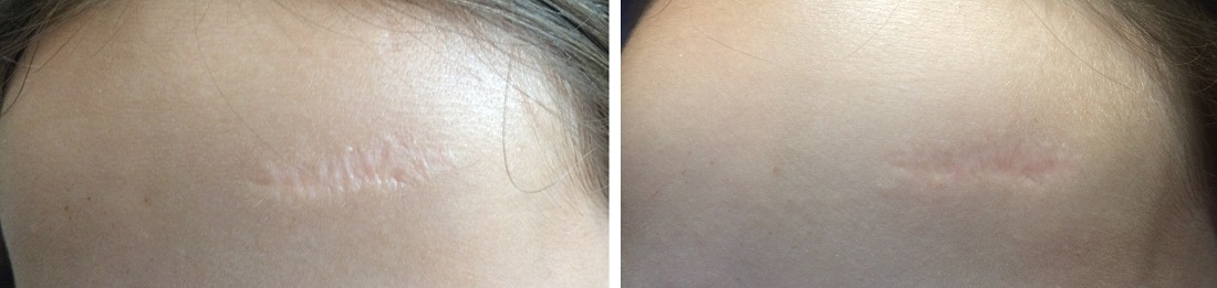 Before and after forehead scar
