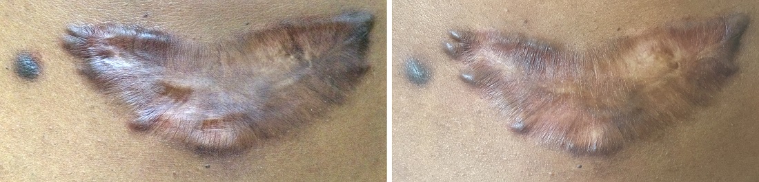 Before and after keloid scar